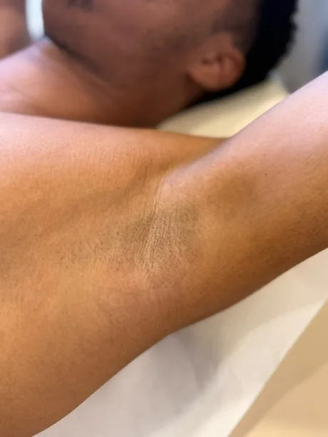 Aisselle d&rsquo;un homme après les séances d&rsquo;épilation laser