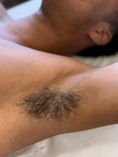 Aisselle d&rsquo;un homme avant les séances d&rsquo;épilation laser