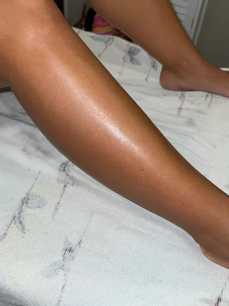 Mollets après quatre séances d'épilation laser