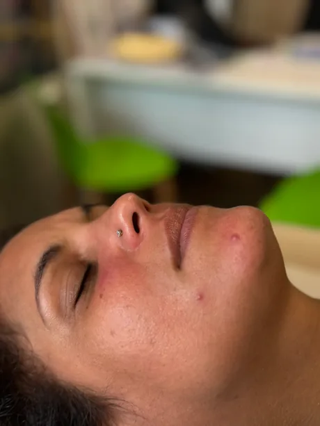 Visage après six séances d'épilation laser