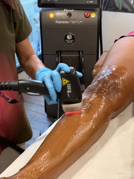 Séance d'épilation laser du mollet au Soprano Titanium, gel de contact appliqué