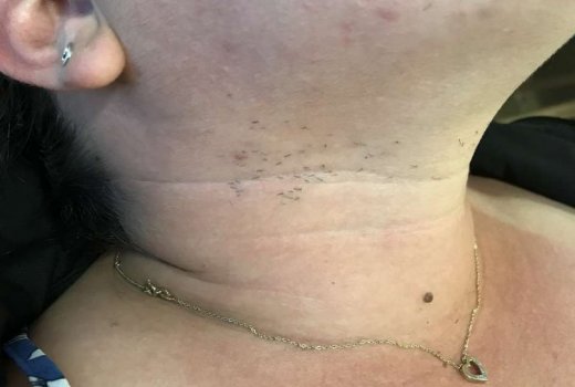 Épilation laser cou femme, 5 séances en 2 mois, Avant/Après  - Sainte-Clotilde - VAME DU BOSQUET