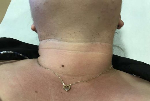 Épilation laser cou femme, 5 séances en 2 mois, Avant/Après  - Sainte-Clotilde - VAME DU BOSQUET