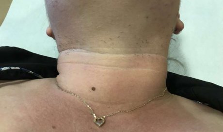 Épilation laser cou femme, 5 séances en 2 mois, Avant/Après  - Sainte-Clotilde - VAME DU BOSQUET